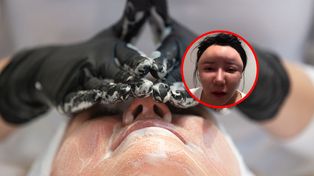 "Bubble face" podbija internet. Lekarz ostrzega: Pojawiają się deformacje i guzy