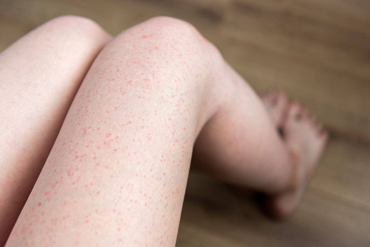 "Truskawkowe nogi"? Czym prędzej wyrzuć z łazienki