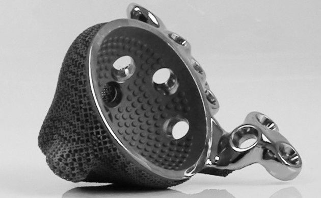 Implant 3d