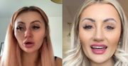 Pomniejszyła usta. Efekt przerósł jej najśmielsze oczekiwania