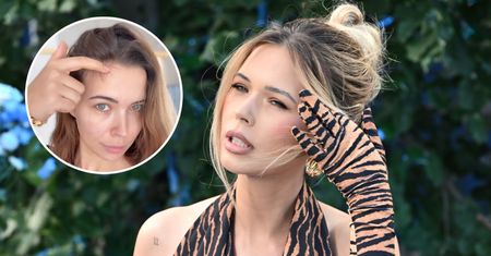 Sandra Kubicka skarży się na kolejny problem po ciąży. "Linia włosów wyraźnie się cofnęła"