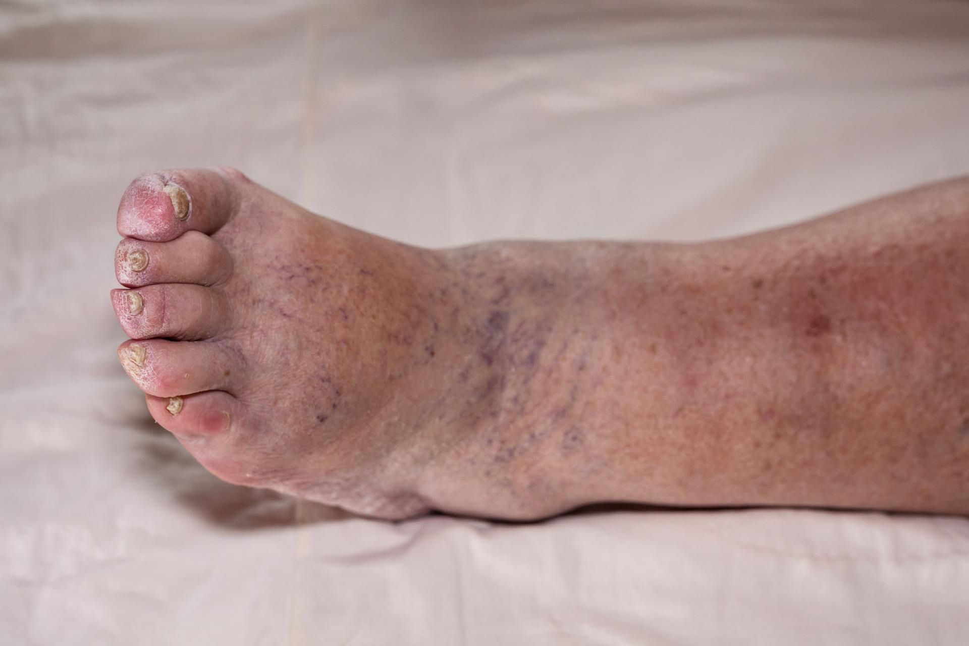 Obrzęk kończyny dolne powstały wyniku przewlekłej niewydolności żylnej.