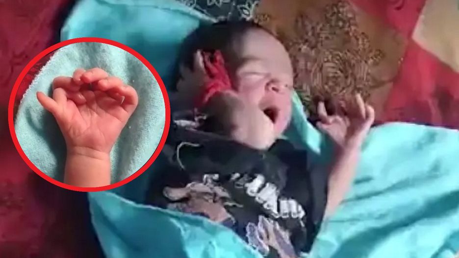 Urodziła się z 26 palcami. Okrzyknięto ją "reinkarnacją hinduskiej bogini"