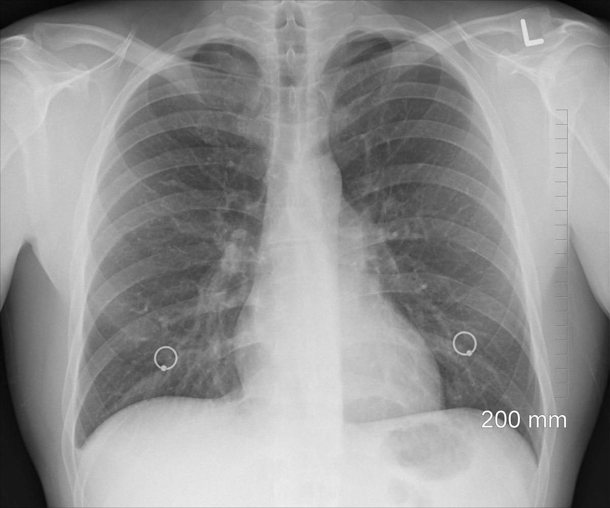 USG płuc pozwoli poprawnie zdiagnozować COVID-19