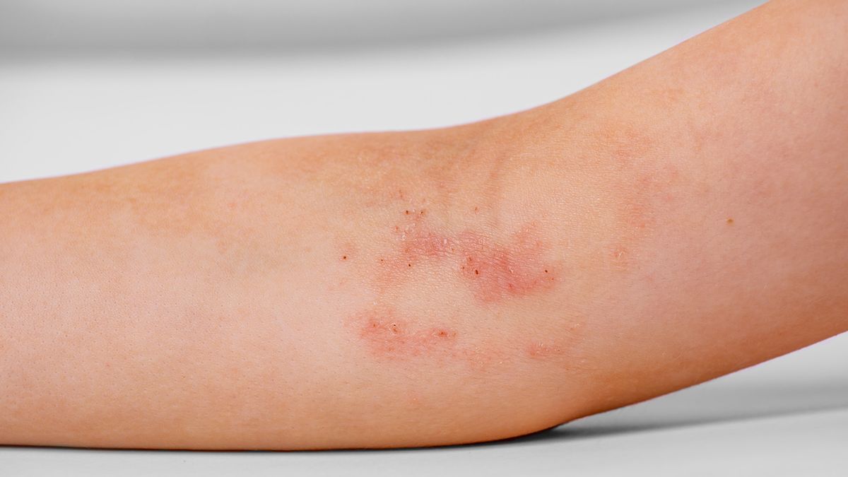 Dermatol wykazuje działanie ściągające, przeciwzapalne, wysuszające i odkażające.