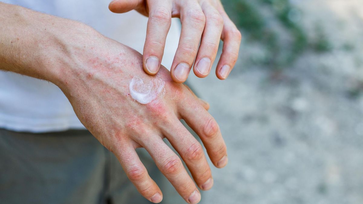 Podrażnienia skóry to częsty problem osób w każdym wieku. 