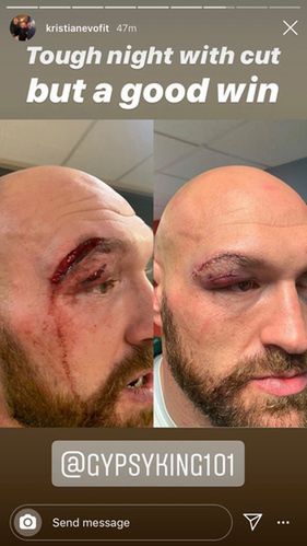 Tyson Fury po walce z Otto Wallinem (fot. za: thesun.co.uk)