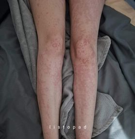 Koronawirus. Pokrzywka po COVID-19 zmieniła życie 21-latki w piekło. "Widok mojej skóry przygnębia"