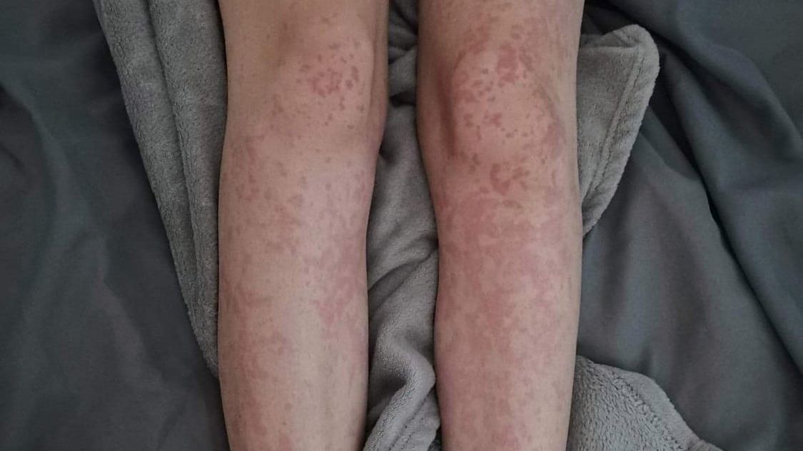 Pokrzywka może pojawić się nawet u 15 proc. pacjentów, u których występują zmiany skórne podczas COVID-19