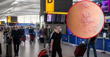 Przypadek rzadkiej choroby tropikalnej w Europie. Mężczyzna zaraził się małpią ospą