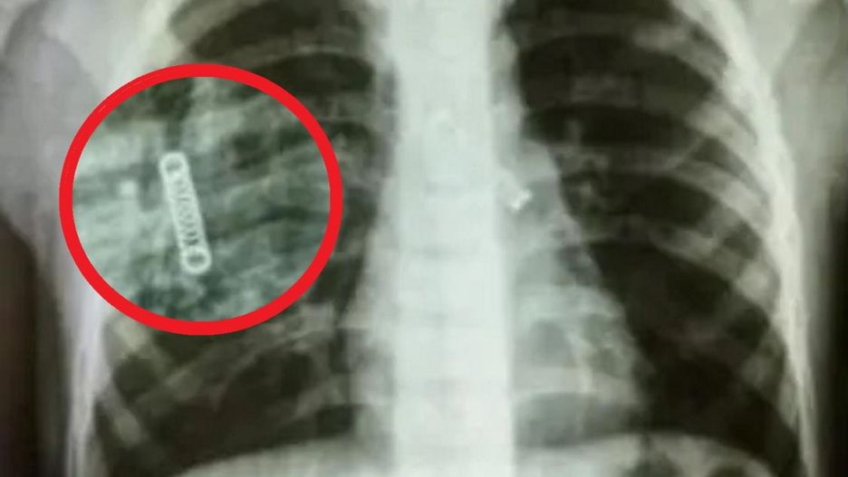 Odkryli to w płucach 5-latka. "Trzy miesiące kaszlu i nikt go nie zabrał do lekarza"