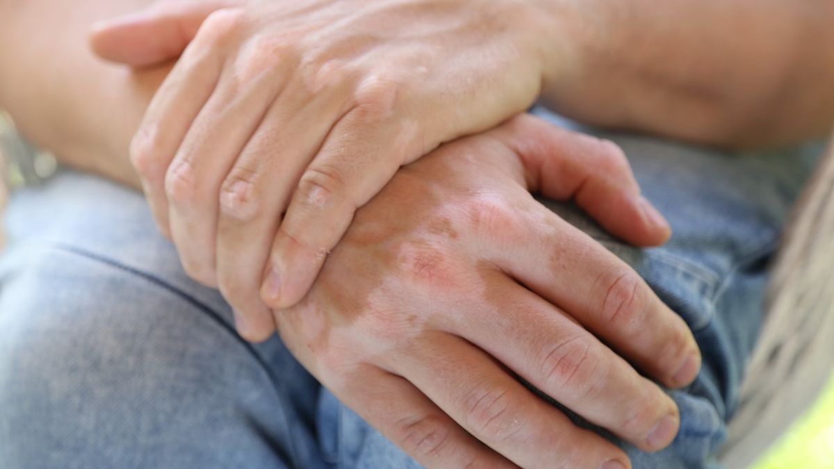 Białe plamy na skórze - produkcja melaniny, opalanie, bielactwo, grzybica skóry