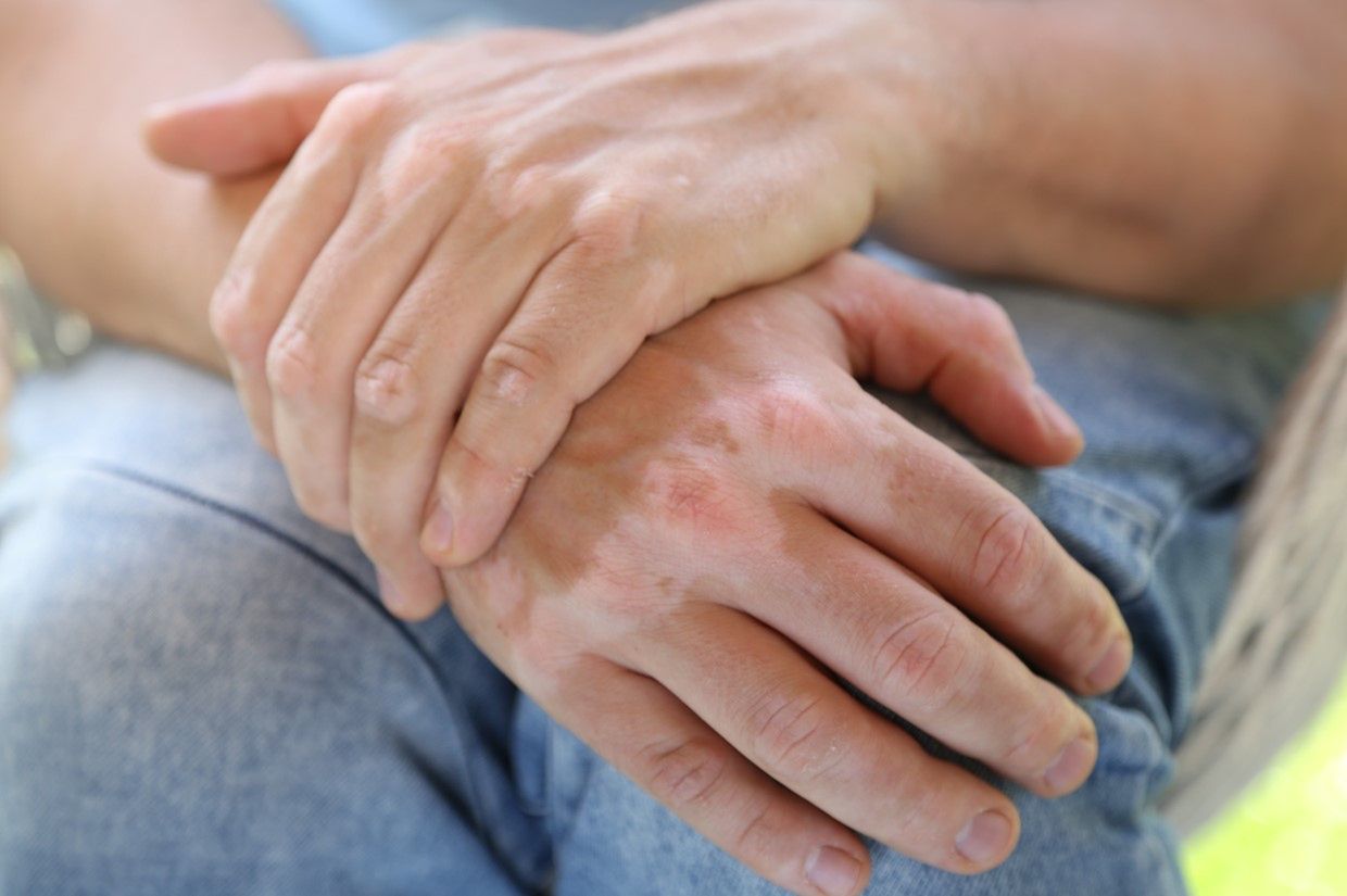 Białe plamy na skórze - produkcja melaniny, opalanie, bielactwo, grzybica skóry