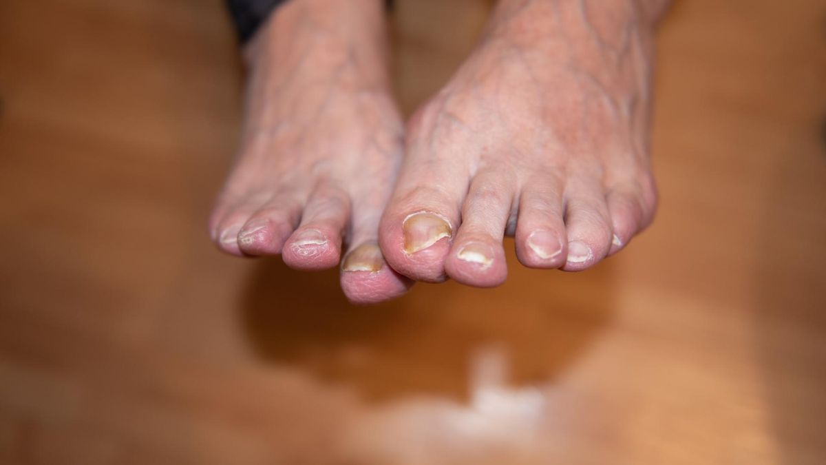 Wysoki cholesterol może prowadzić do rozwoju miażdżycy