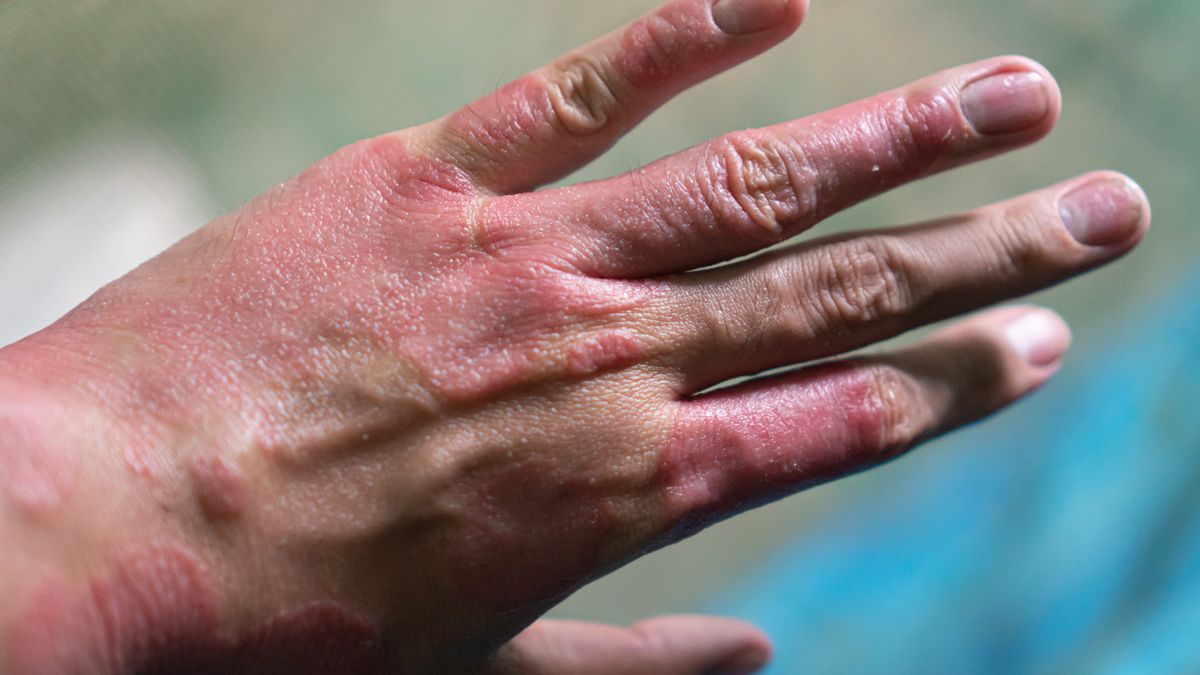 Objaw cukrzycy może pojawić się na dłoniach