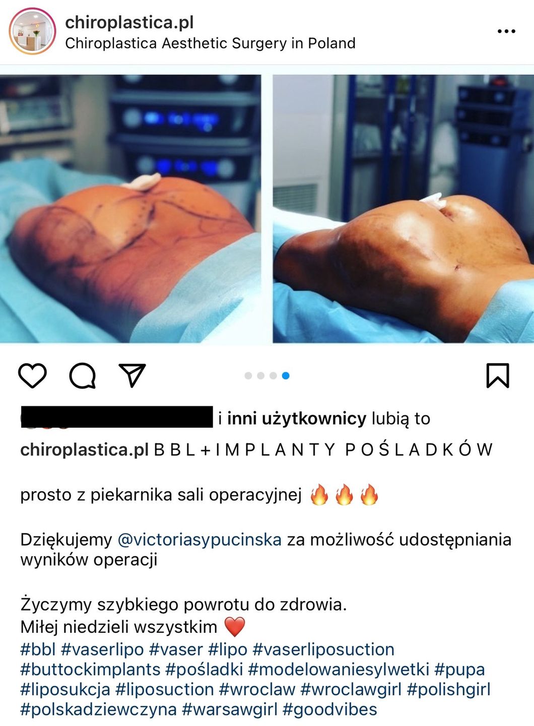 Recydywistka operacji plastycznych Wiktoria Sypucińska (tym razem) POWIĘKSZYŁA POŚLADKI