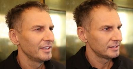 Chirurg TVN-u: "NFZ powinien refundować operowanie blizn po wypadkach!"
