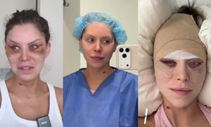 Zabandażowana i obolała Julia von Stein pokazuje się po pierwszej POPRAWCE LIFTINGU TWARZY. "Modlę się, żeby było lepiej"