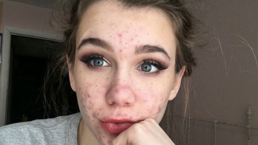 Emma walczy z trądzikiem