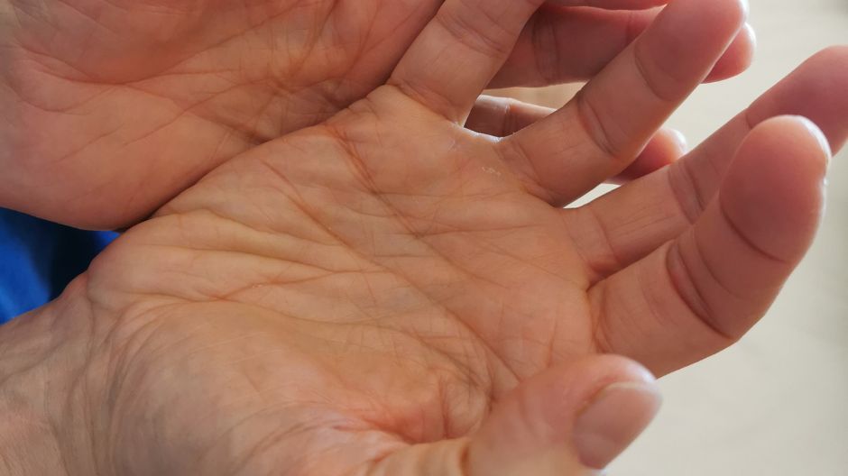 Te palce mogą zwiastować chorobę