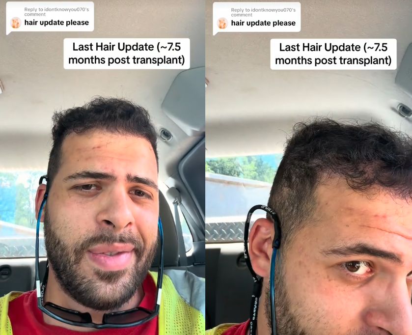 Przeszczepił włosy w Turcji. Oto jego historia