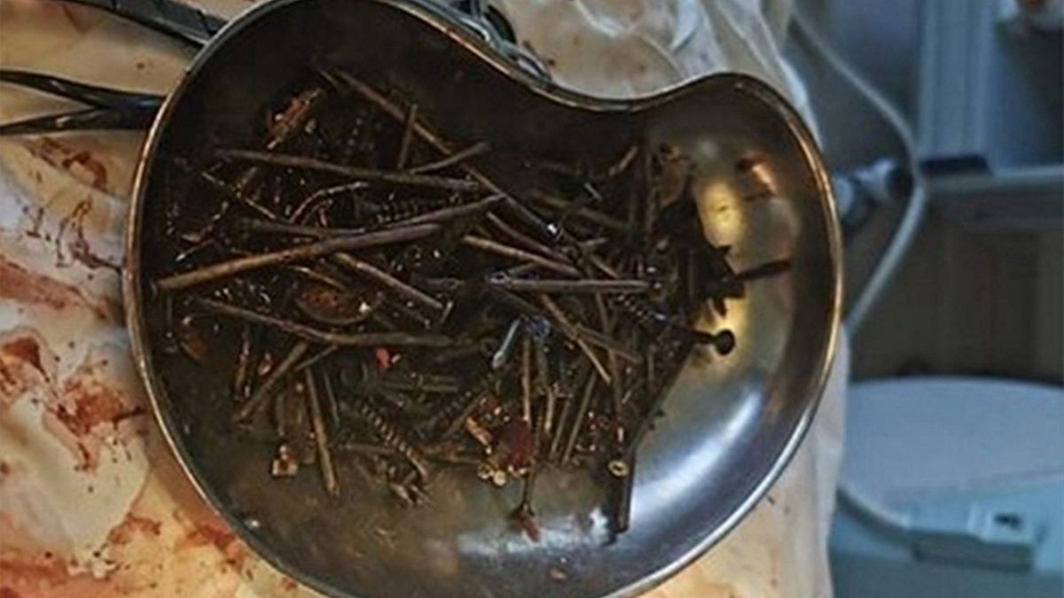 Z żołądka pacjenta wyciągnięto śruby i gwoździe