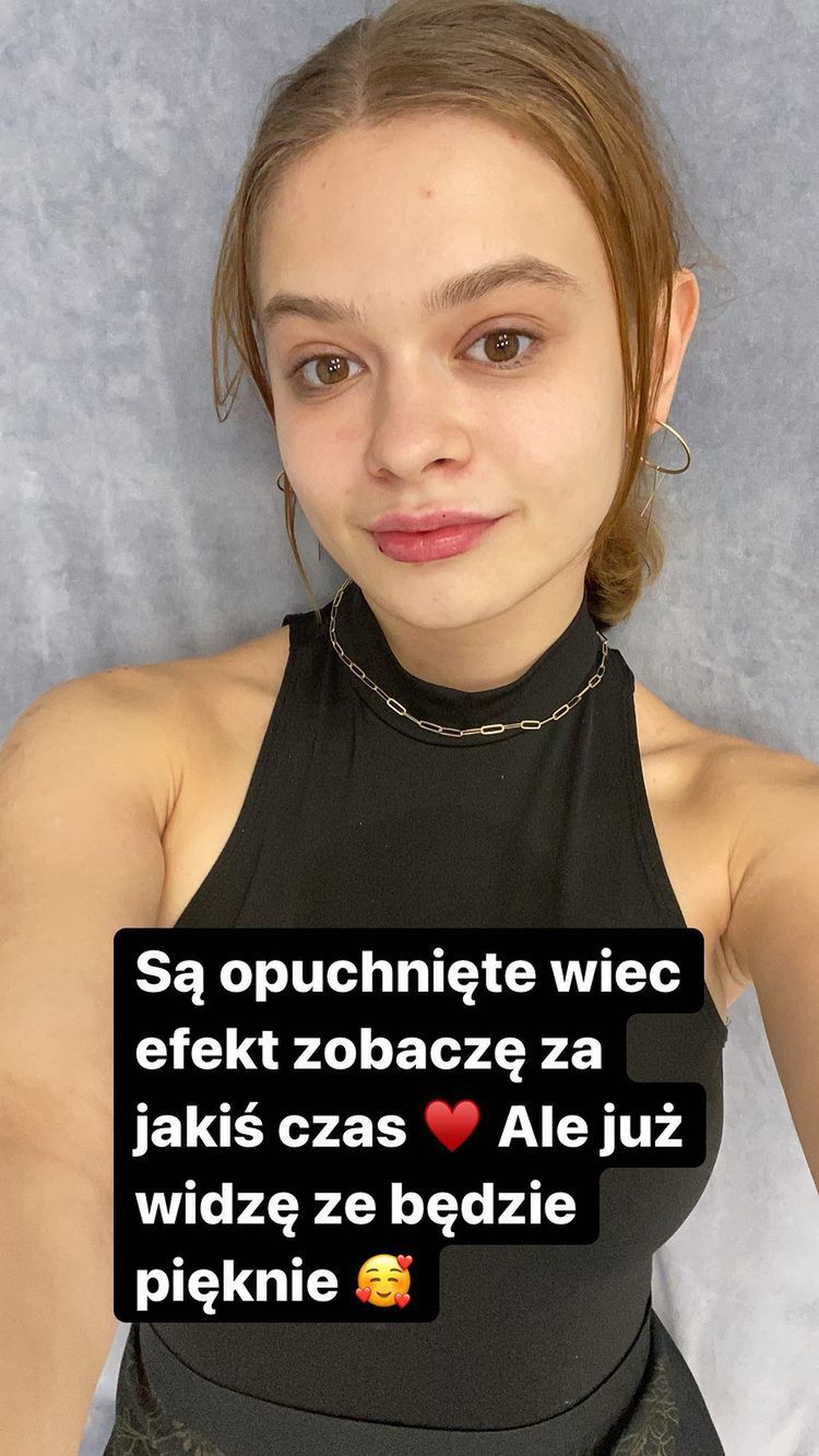 Julia Wróblewska powiększyła usta