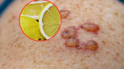 Latem powodują oparzenia. Mówią o nich "margarita burn"