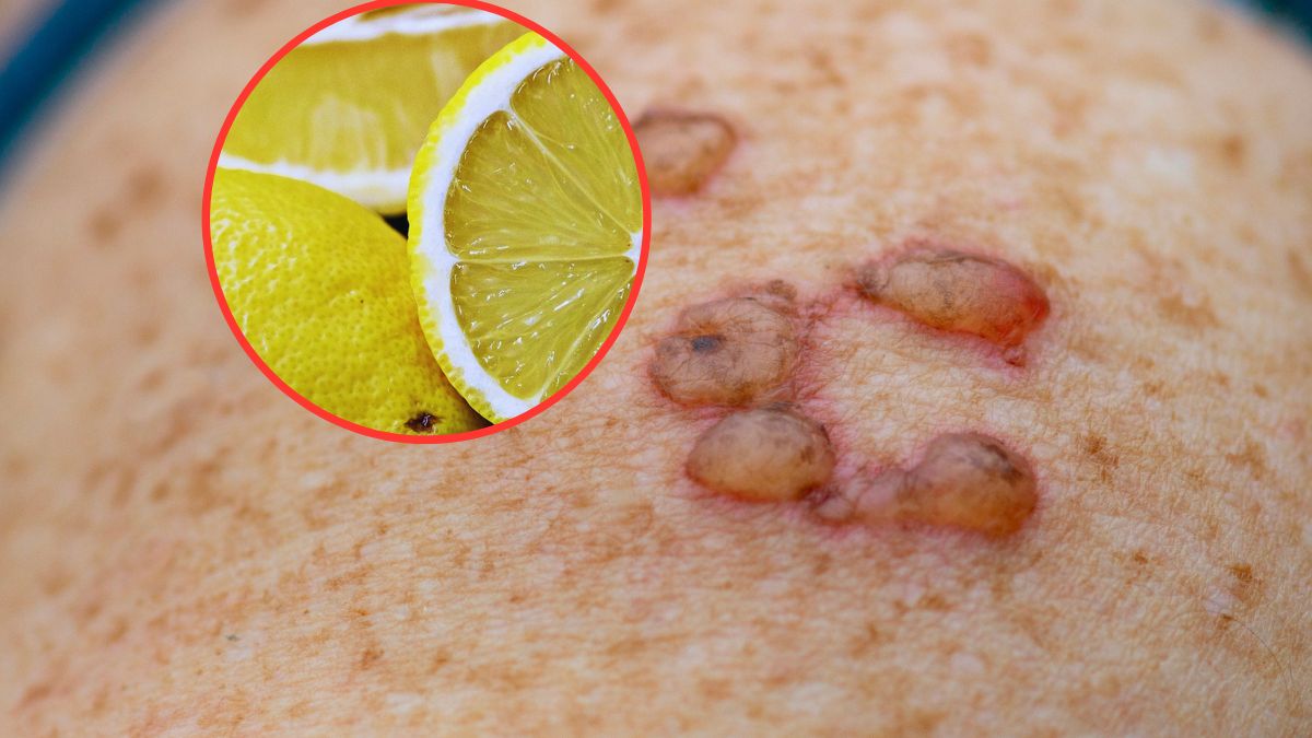 Czym są oparzenia typu "margarita burn"?