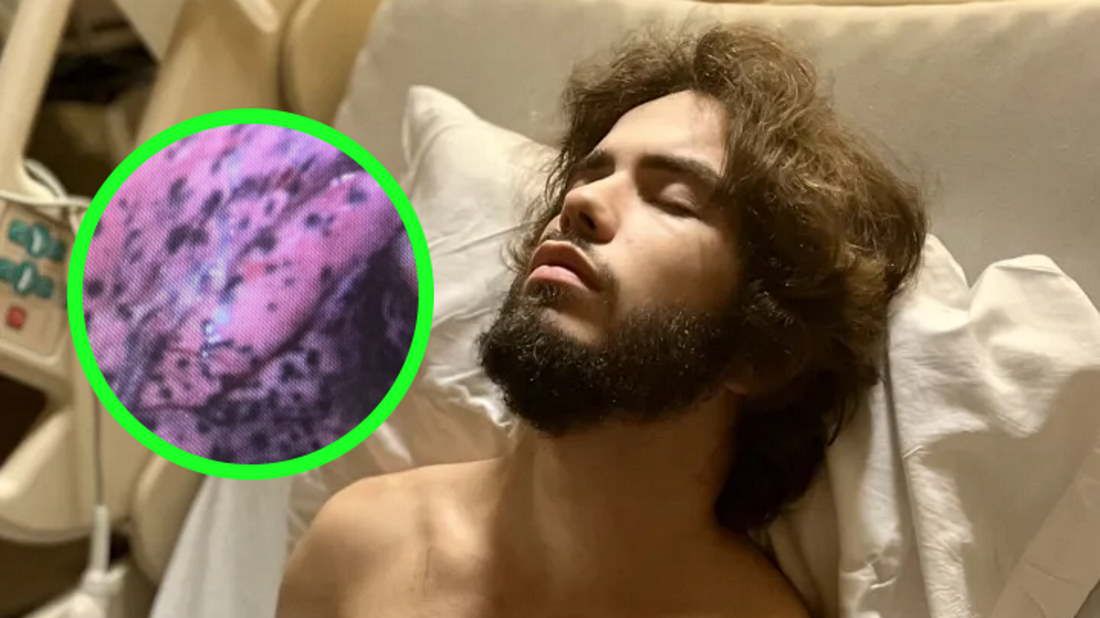 Były usiane czarnymi plamami. Lekarze musieli usunąć 20-latkowi fragment płuca