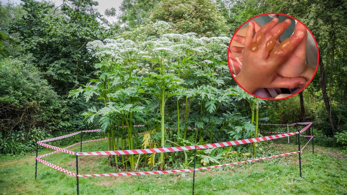4-latek bawił się w parku. Doznał oparzeń drugiego stopnia