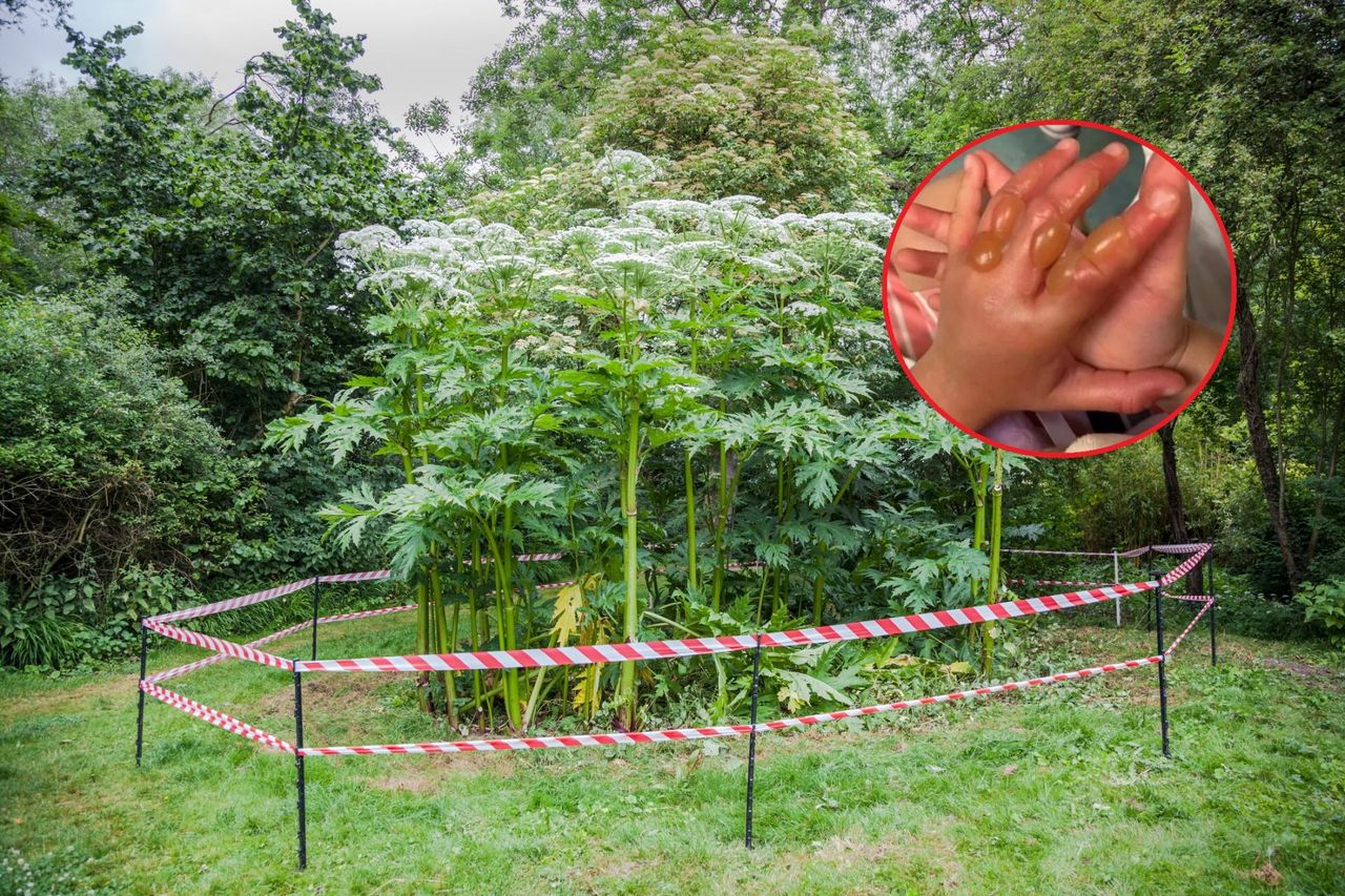 4-latek z oparzeniami trafił na ostry dyżur. Otarł się o toksycznego krewniaka barszczu Sosnowskiego