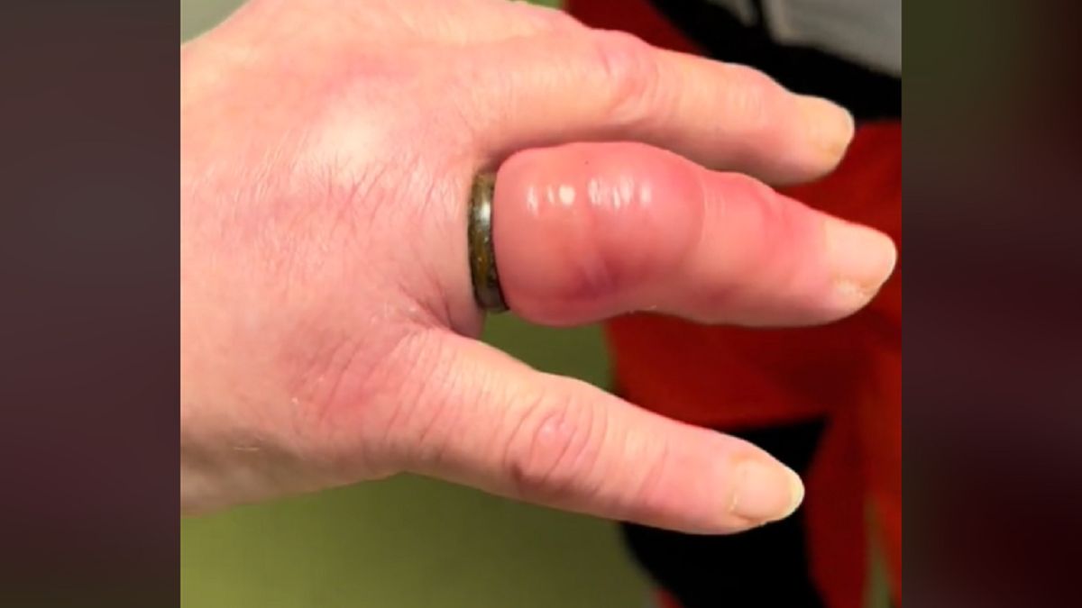 "Mało brakowało". Ratownik wolontariusz "Borkoś" ratował palec pacjentki. 