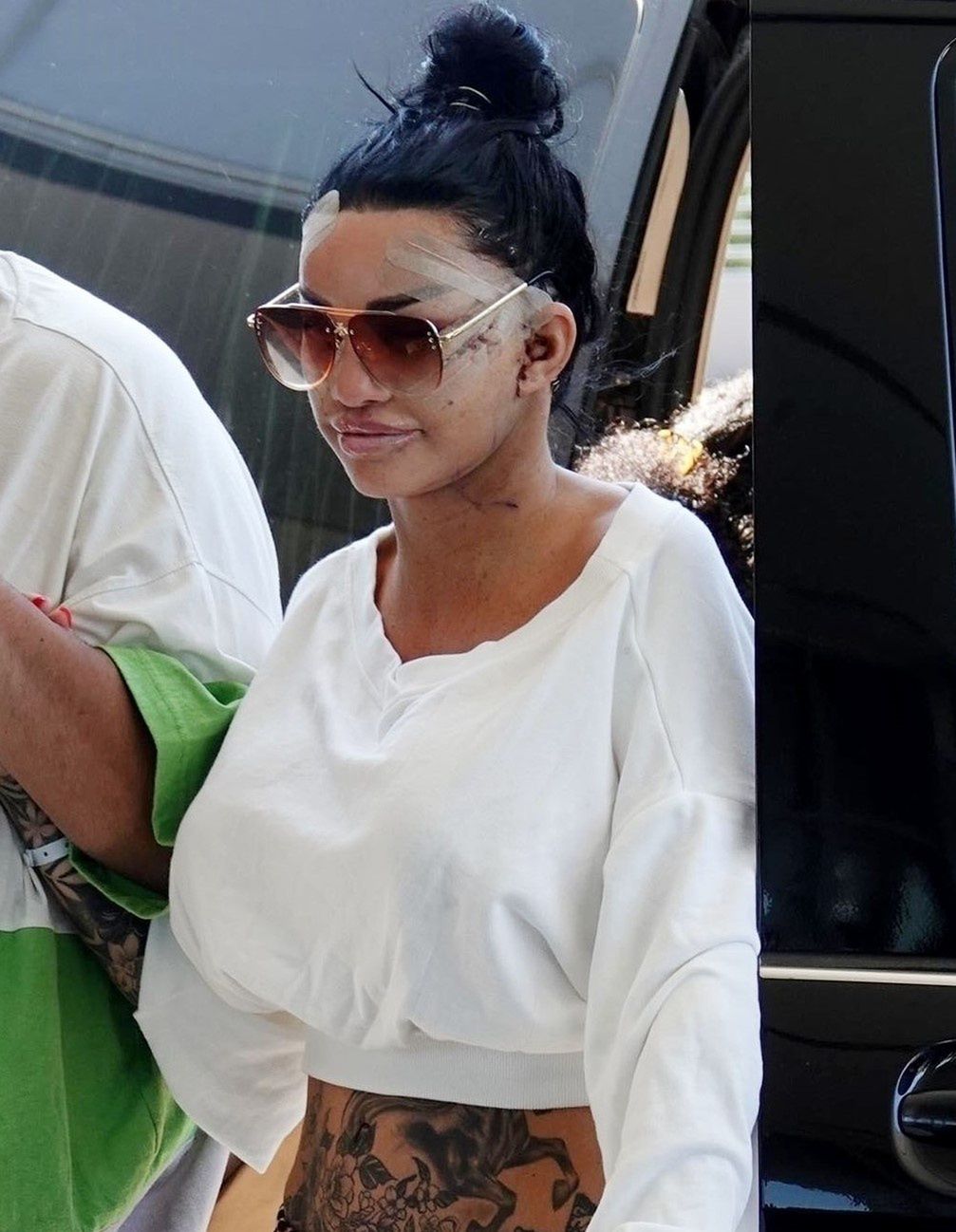 Katie Price sfotografowana tuż po wykonaniu 6. liftingu twarzy 