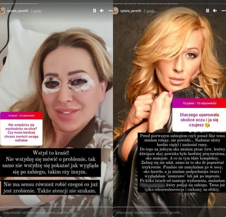 Sylwia Peretti chwali się zabiegiem na powieki