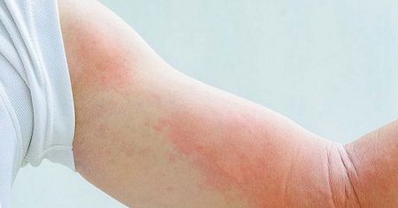 Objawy przypominają alergię. Zwiastują wstydliwą, groźną chorobę