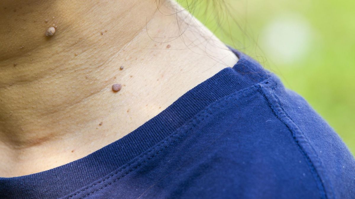 Zmiany skórne w okolicach szyi