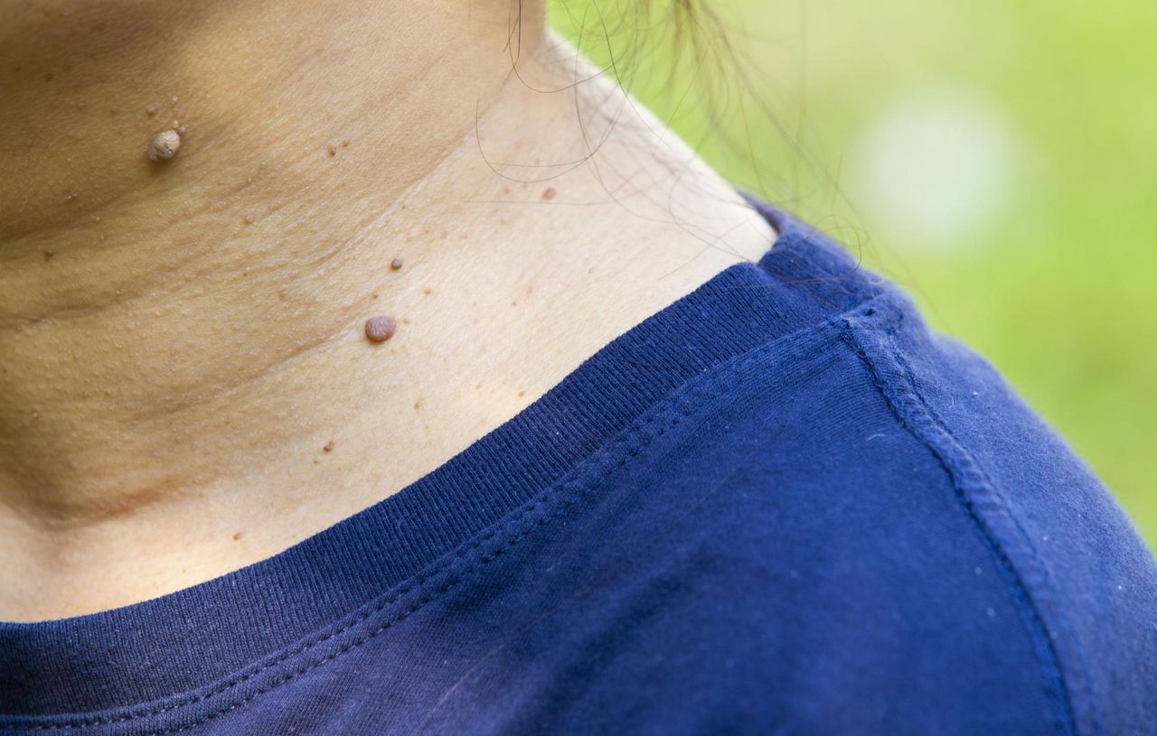 Brodawki w okolicy szyi: czego mogą być objawem i czy słusznie nas niepokoją?