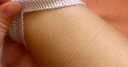 Masz takie ślady po skarpetkach? Flebolog stawia sprawę jasno