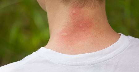 Komary gryzą za "słodką krew"? Dermatolog wyjaśnia mit