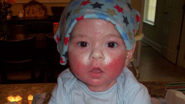 Chłopczyk miał bolesną chorobę skóry