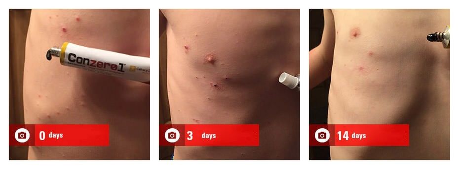 W przypadku mięczaka zakaźnego kuracji powinni poddać się wszyscy domownicy