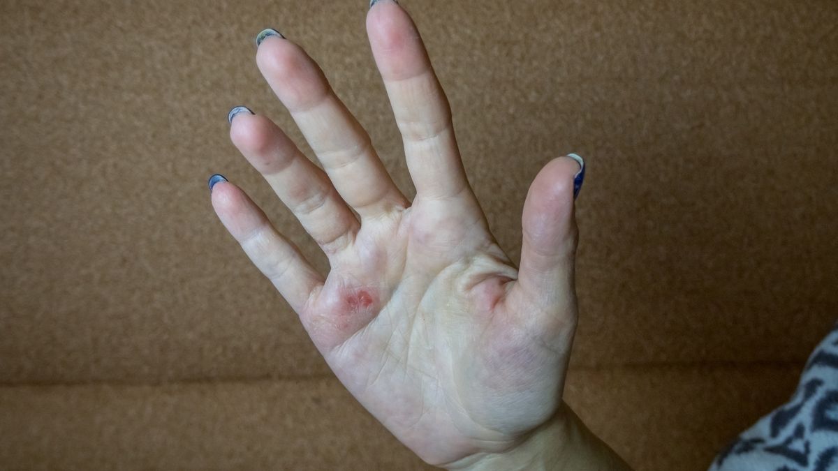 Gdy pojawią się na dłoniach, mogą sygnalizować raka żołądka