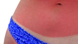 Oparzenie - jak uniknąć dalszych szkód 1