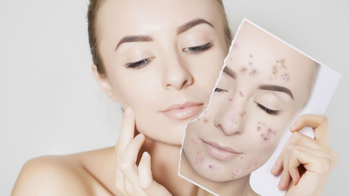 Wyciskanie pryszczy wielu osobom poprawia komfort psychiczny, ponieważ uważają, że wyciśnięta niedoskonałość staje się mniej widoczna