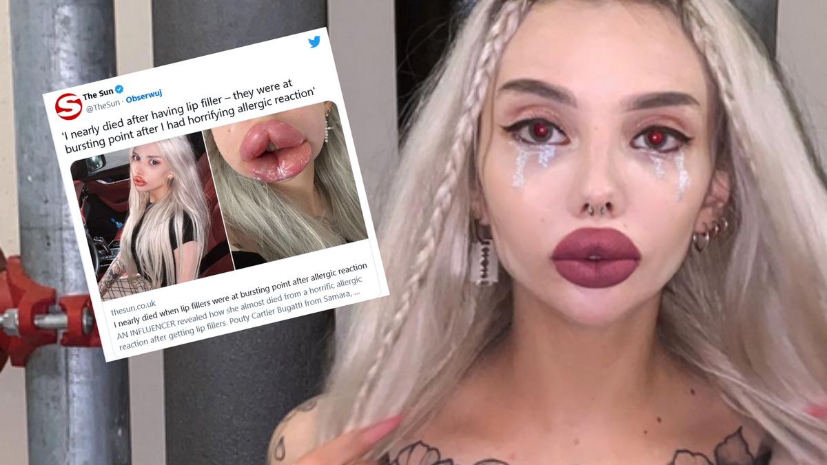 Powiększyła usta. Omal nie umarła przy ich zmniejszaniu. 