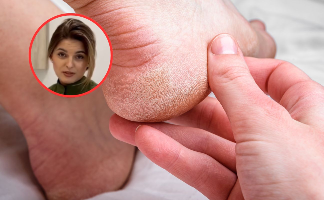 Podiatrist warns: popular heel creams damage skin instead of healing it