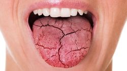 Choroba Behceta - przyczyny, objawy, diagnostyka i leczenie