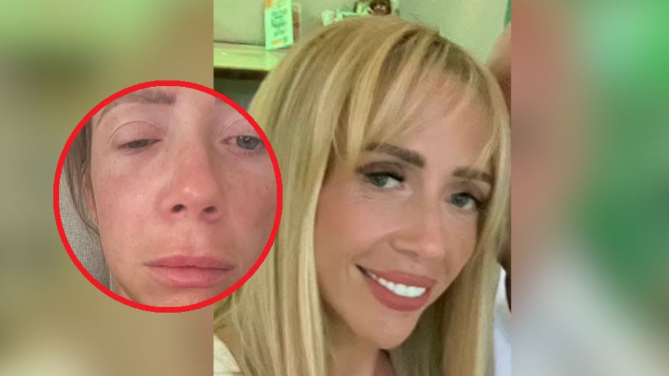 Lekarze myśleli, że to nowotwór. Tak objawiały się powikłania po liftingu twarzy