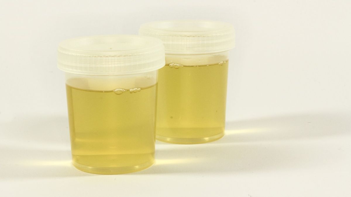 Dobowa zbiórka moczu to jedno z częściej zlecanych badań. Dzięki niemu można uzyskać informacje nie tylko o pracy układu moczowego, ale i całego organizmu.